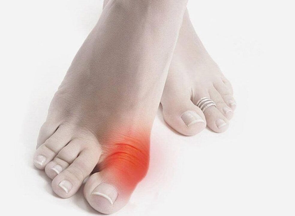 simptomi gihta stopala